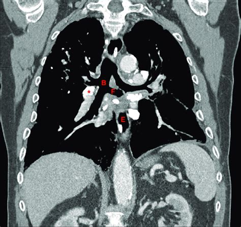 Coronal Segment Of A Contrast Enhanced Chest Ct Scan Revealing An Open