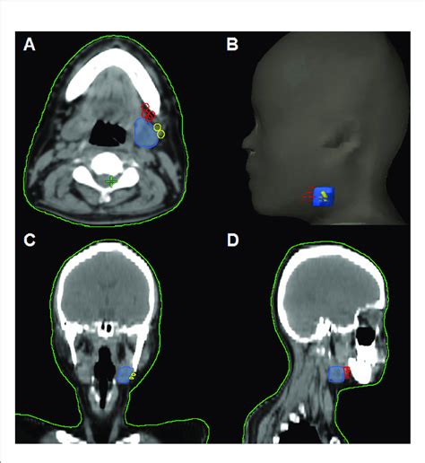 The Patterns Of Peri Submandibular Lymph Node Metastases In Axial