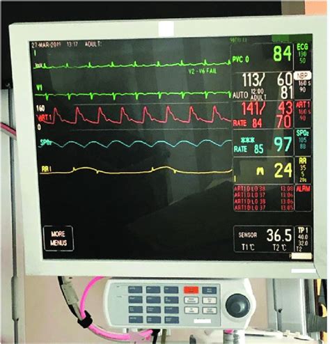 A Photo Of A Bedside Patient Monitor In Use At A Medical Surgical