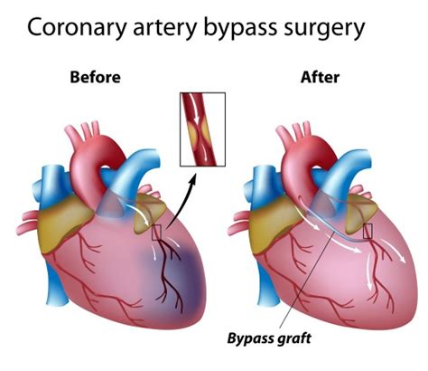 Heart Bypass Surgery Explained In Incredible Pictures Myheart