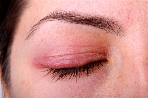 Inflammation Of Eyelid