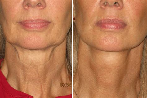 8 Tips To Recovering From A Neck Lift Las Vegas Neck Lift The