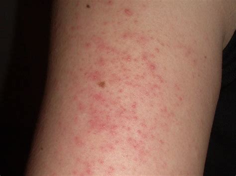 Breaking Out In Itchy Bumps Why A Skin Rash May Be A Coronavirus