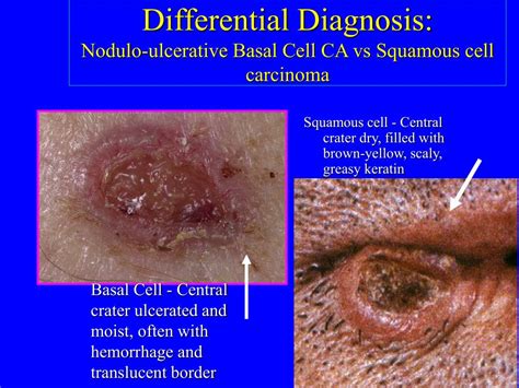 Ppt Skin Pathology Pigmented Lesions Neoplasms Immune Mediated