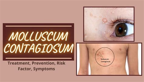 Molluscum Contagiosum Genital Area Treatment