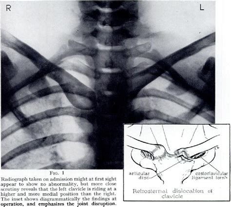 Figure I From Retrosternal Dislocation Of The Clavicle Semantic Scholar