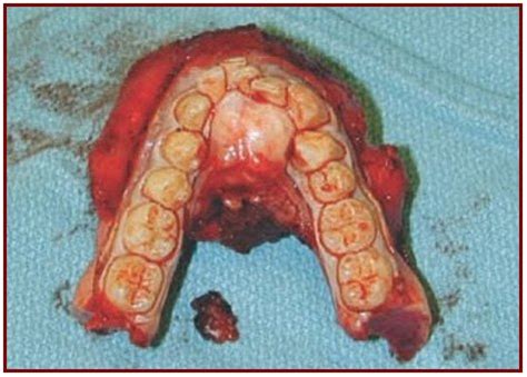 Gums Of Mouth Cancer X Ray