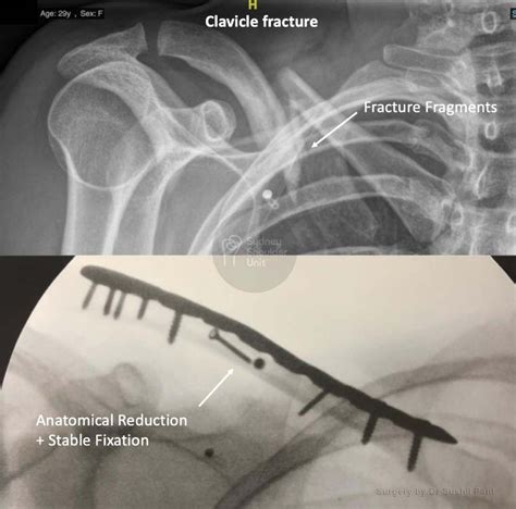 Broken Collarbone Medical Case Study Sydney Shoulder Unit