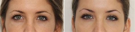 Eyebrow Lift In Delhi By Dermal Fillers Dermaworld Skin Clinic
