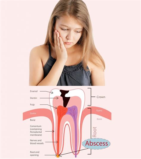 Tooth Abscess Swollen Face