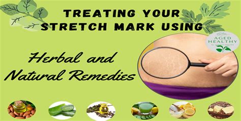 Treating Your Stretch Mark Using Herbal And Natural Remedies Herbal