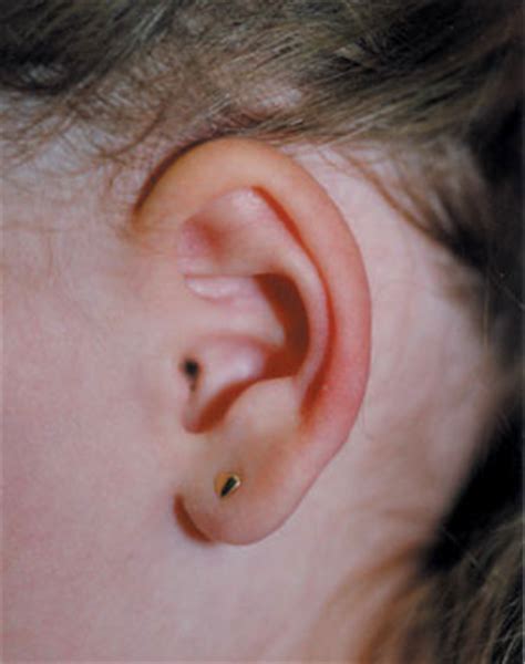 Patients may also experience pain, impaired hearing infections of the ear canal involving fungi, viruses, or bacteria are common culprits. Outer ear infection (otitis externa). Causes, symptoms ...