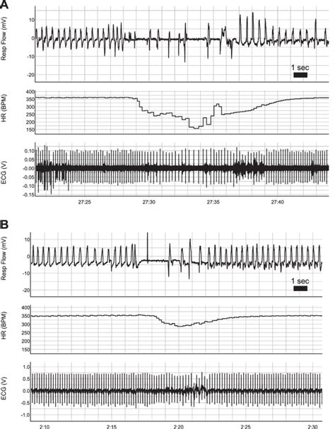 Examples Of Bradycardia Associated With Breathing Disruptions In