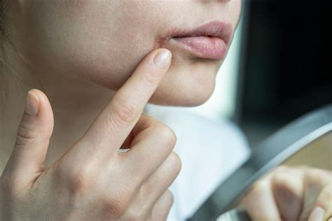 Lip Lickers Dermatitis Symptoms Causes Treatment Verywell Health
