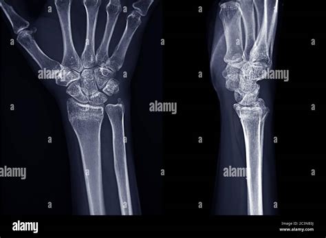 X Ray Image Of Right Wrist Joint Ap And Lateral View For Diagnosis