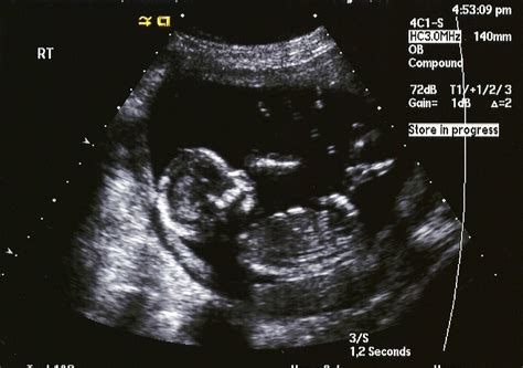 Smithback Twins 16 Week Ultrasound Pictures