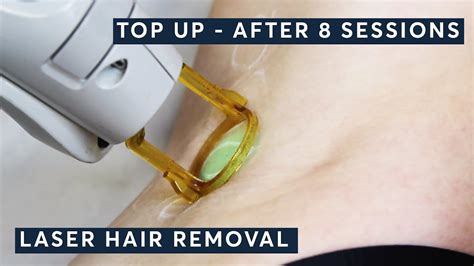 Top Up After 8 Sessions Of Laser Hair Removal Youtube