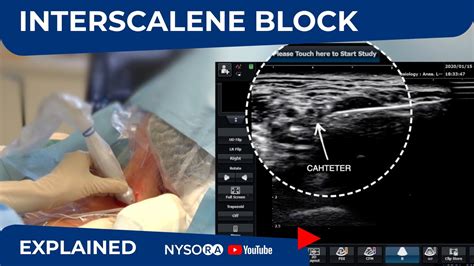 Ultrasound Guided Continuous Interscalene Block Regional Anesthesia