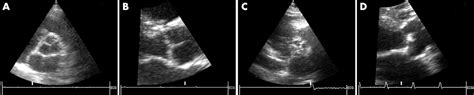 Aortic Sclerosis Not An Innocent Murmur But A Marker Of Increased