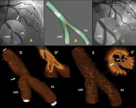 In Vivo Flow Simulation At Coronary Bifurcation Reconstructed By Fusion