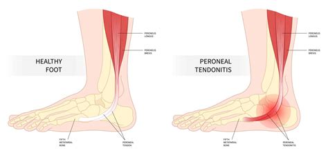 Peroneal Tendonitis And Tendinopathy Causes Symptoms Treatment And The Best Porn Website