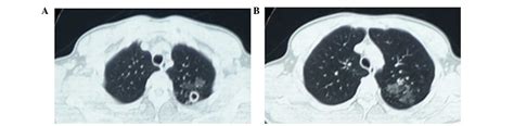 Acute Tuberculous Myopericarditis Mimicking Acute Myocardial Infarction