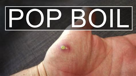 How To Lance Pop Boil Cyst Youtube