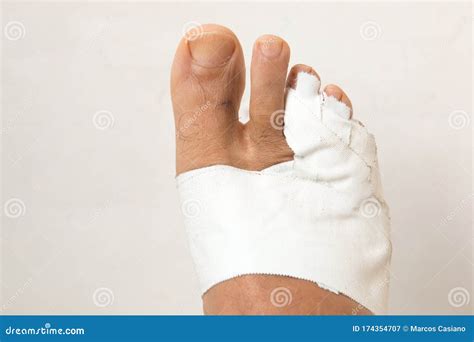 Mans Bandaged Up Broken Toe Stock Image Image Of Crack Aging 174354707