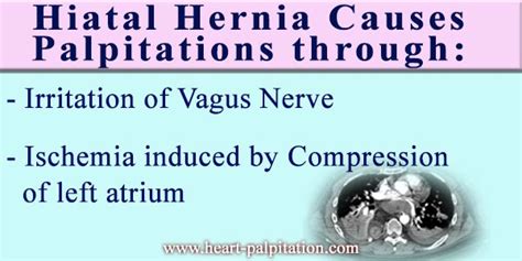 Hiatal Hernia Palpitations Heart