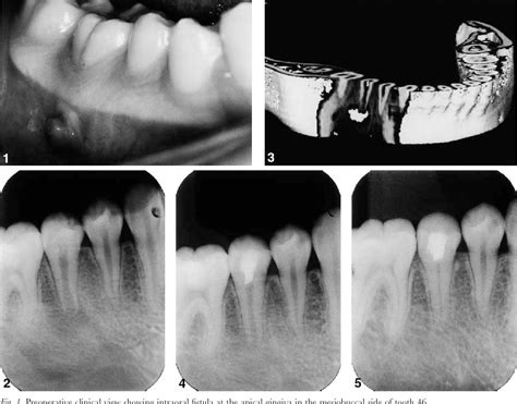 Revascularization Of Immature Permanent Teeth With Apical Periodontitis My Xxx Hot Girl