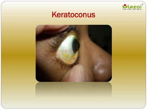 PPT Keratoconus Causes Symptoms Daignosis Prevention And