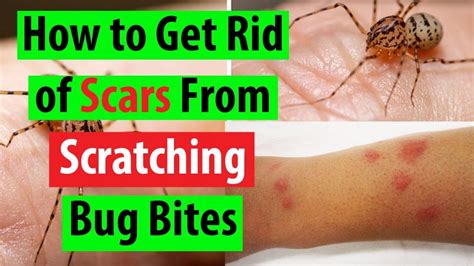 How To Get Rid Of Bed Bug Bite Scars Proven Tips From Bug Experts