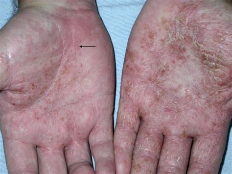 Hand Eczema Hand Dermatitis
