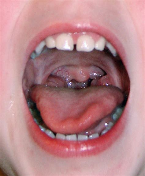 T Cells As In Tonsils Zdnet
