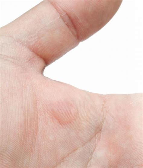 What Are Common Causes Of Blisters With Pictures