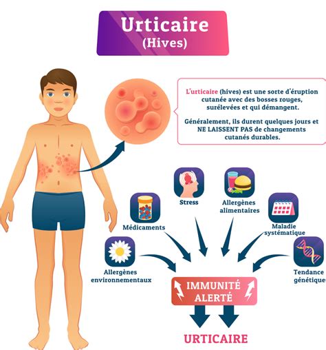Urticaire Causes Sympt Mes Et Traitements Information Hospitali Re Lexique Et Actualit