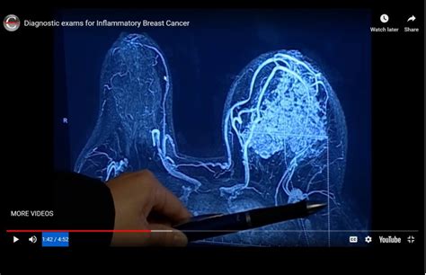 Diagnosing Inflammatory Breast Cancer The Ibc Network Foundation