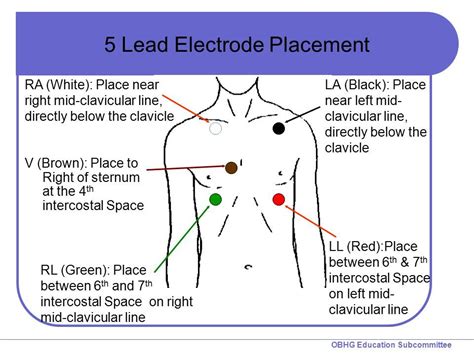 The Gallery For Telemetry Monitoring Lead Placement