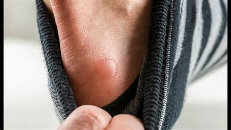 The Basics Should You Pop A Blister Youtube