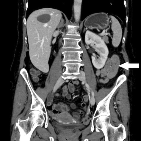Abdominal Ct Scan Coronal Image In The Most Dorsal Sections Small
