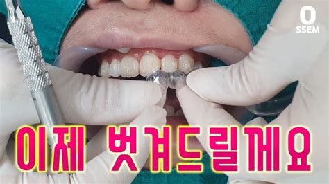 치아교정 시작 인비절라인 어태치먼트 부착 하는날 투명교정기 붙이기 Youtube