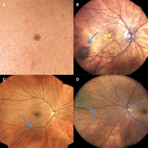 The Ultimate Guide To Diagnosing A Choroidal Nevus Eyes On Eyecare