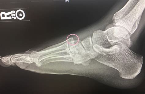 Lisfranc injuries can also result simply from missing the last step on the stairs; R foot Lisfranc Injury. Lateral Radiograph. Annotated ...