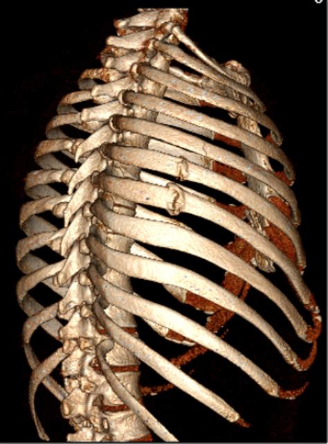 Rib Plating Of Acute And Sub Acute Non Union Rib Fractures In An Adult