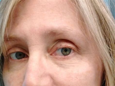 Basal Cell Carcinoma On Lower Eyelid Surgery And Recovery Organized 31