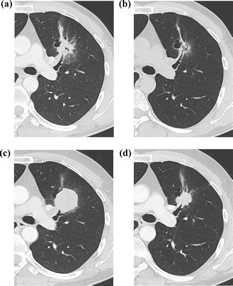 Computed Tomography Ct Scan Of The Left Lung A Ct On Admission