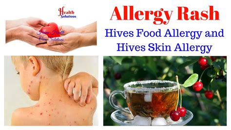 Allergy Rash Hives Food Allergy And Hives Skin Allergy Youtube