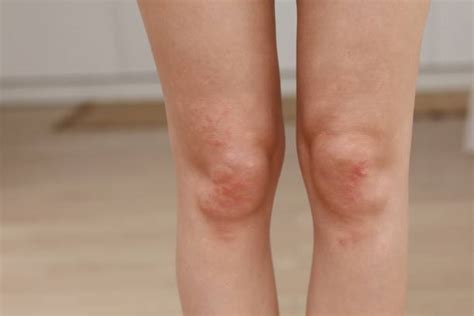 Psoriasis Legs Stock Photos Pictures And Royalty Free Images Istock