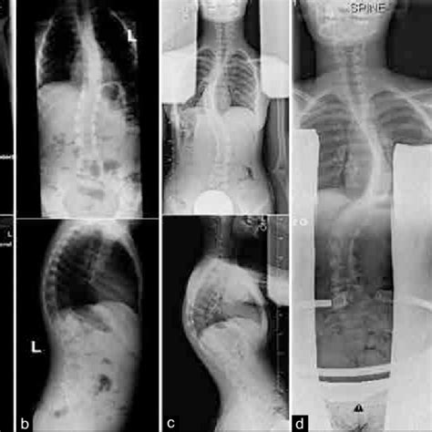 Preoperative Standing Scoliosis Radiographs Including Right Lateral