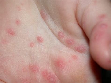 Hand Foot Mouth Disease Picture Hardin Md Super Site Sample